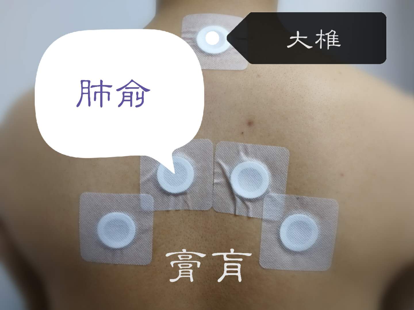 沈阳名中医讲解,有图有真相:周末三九贴敷,穴位用药作用这么看