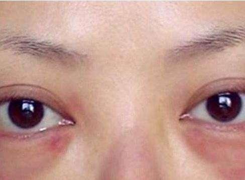 睫毛也能烫,睫毛可以烫了再种吗