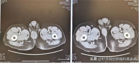 肛肠难言之隐,直肠癌常见的转移部位
