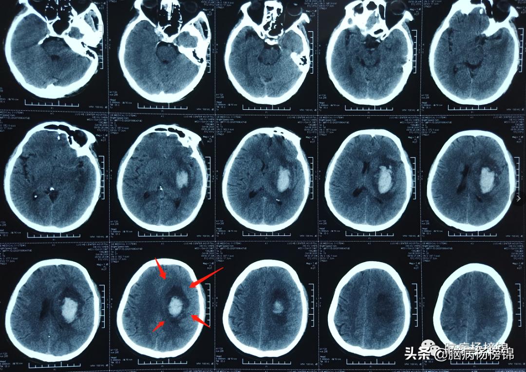高空掉落脑出血,高处作业会不会引起脑溢血