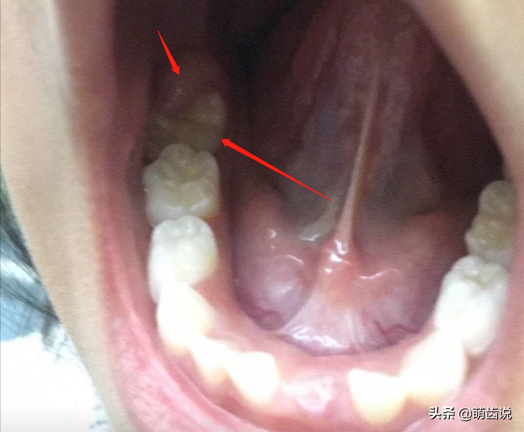 宝宝六龄牙怎么保护,六岁孩子牙做什么保护