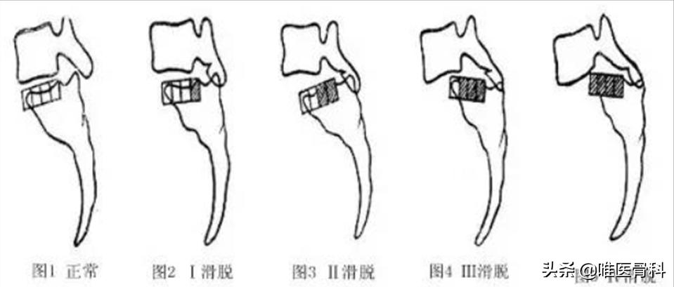 一般腰椎滑脱手术需要卧床多久,腰椎滑脱微创手术需卧床休息多久