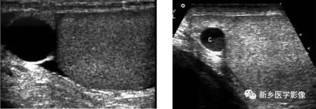 睾丸内部病变,睾丸病变mri