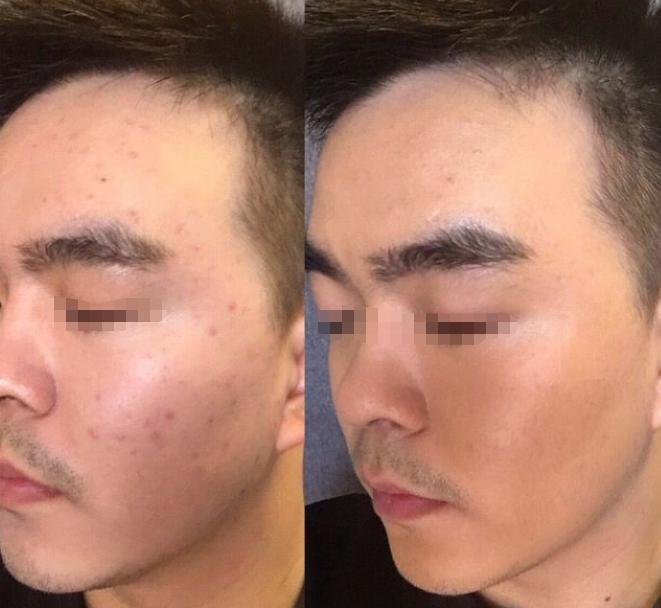 痘痘防止复发的方法是什么,反复长痘怎么解决改善痘痘肌