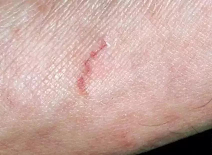 尘螨叮咬怎么治疗,螨虫叮咬传播疾病