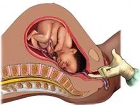 凌晨4点，我被产房助产士紧急唤醒，争分夺秒抢救脐带脱垂的孕妈