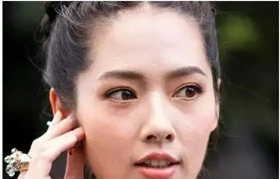 女生闭口粉刺怎么办,有闭口粉刺做什么医美