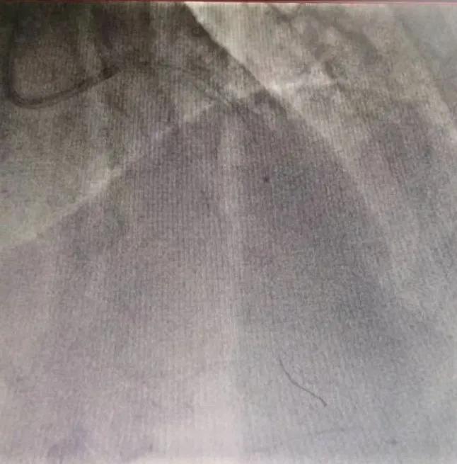 北京积水潭医院心内科成功开展医疗新技术！准分子激光冠脉消蚀术与冠脉旋磨术治疗冠脉钙化病变