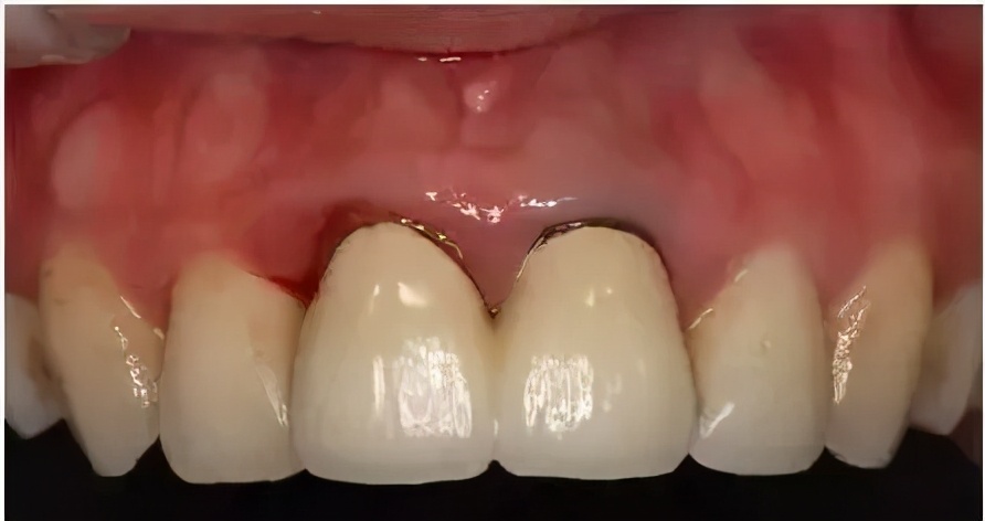 烤瓷牙基底冠如何清洁不崩瓷,烤瓷牙咬合面崩瓷必须重做吗