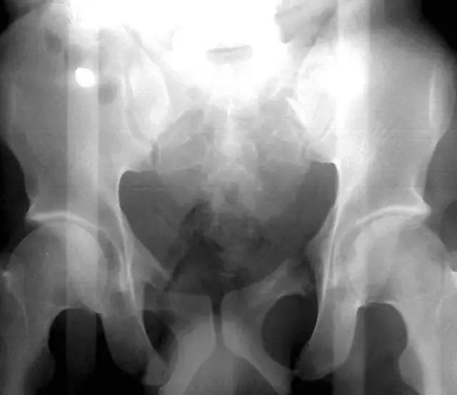 特殊骨折类型,特殊骨折体征