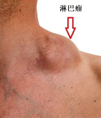 免疫病和免疫系统疾病一样么,常见的免疫疾病有哪些