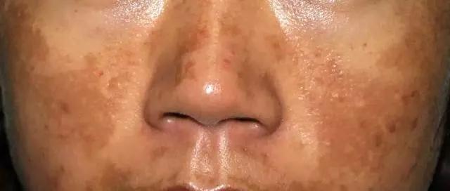 脸上的斑分为几种类型,脸上常见的6种斑