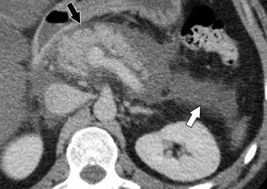 急性胰腺炎影像检查首选,急性坏死胰腺炎影像