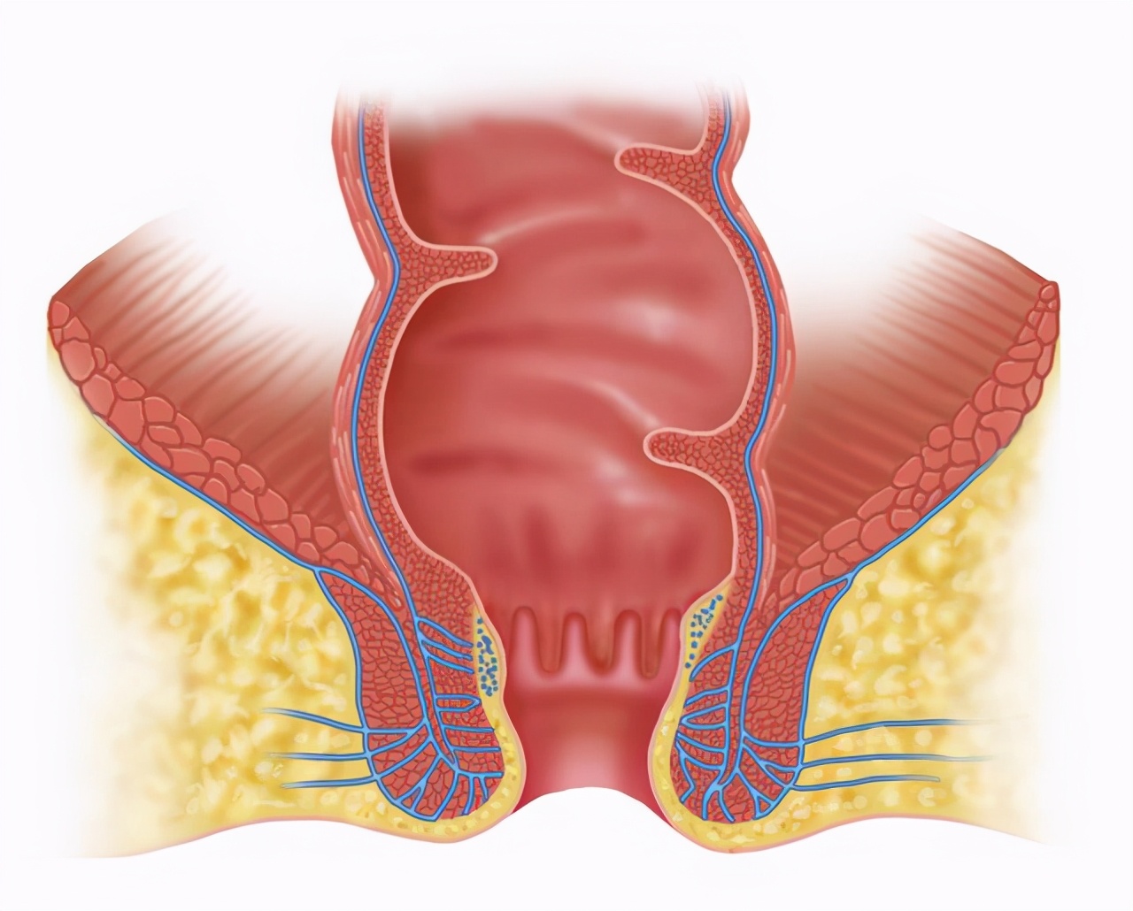 痔疮肛门周围都肿是什么痔疮,肛门肿胀有痔疮疼痛