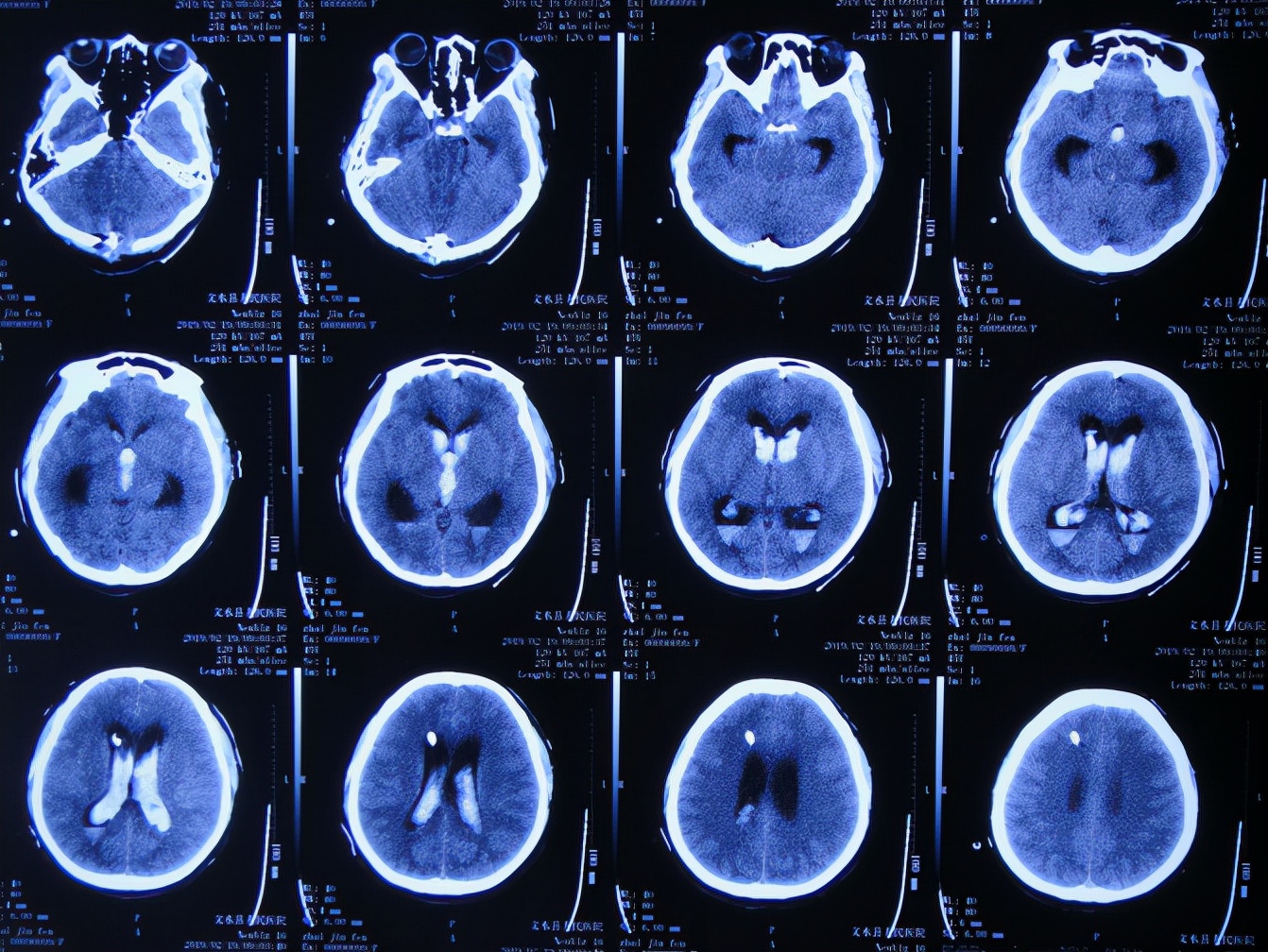 脑出血后脑积水会造成意识不清吗,脑出血后脑积水发高烧危险期多久