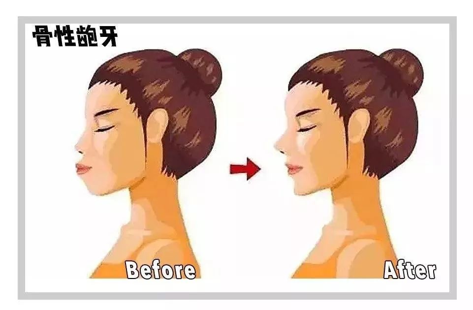 龅牙和深覆合有什么区别,龅牙矫正出现深覆合正常吗