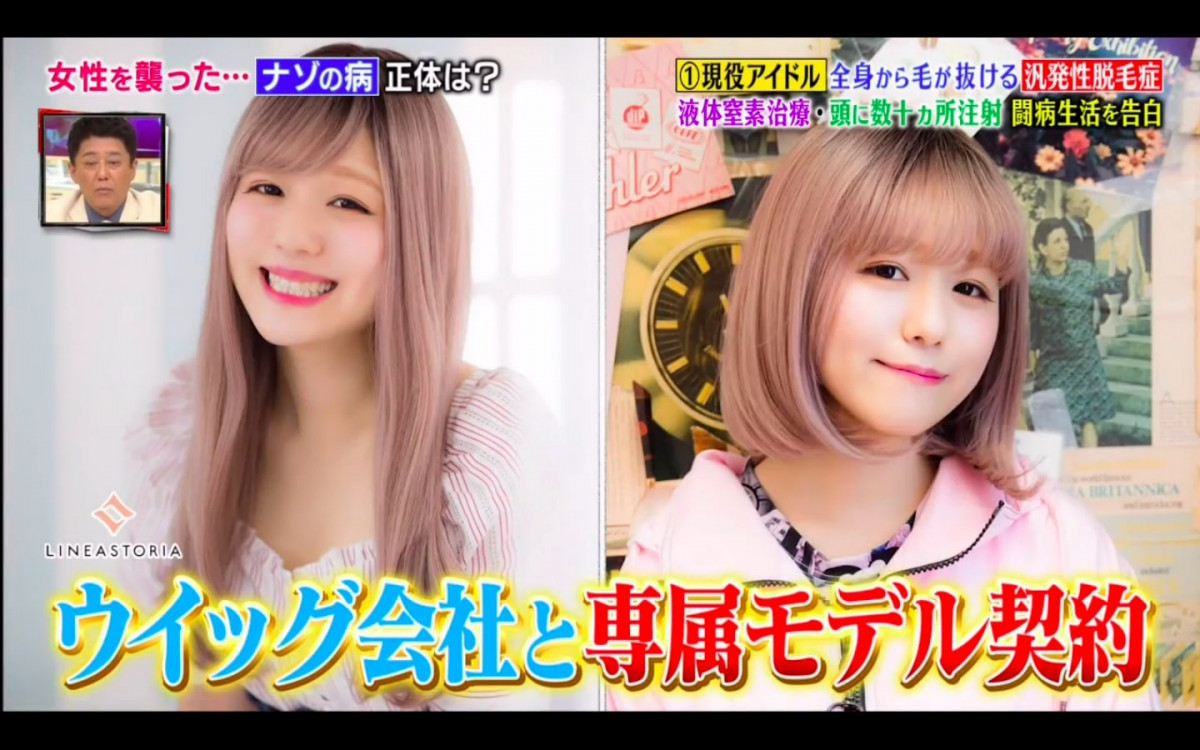 日本15岁脱毛症状,日本脱毛症