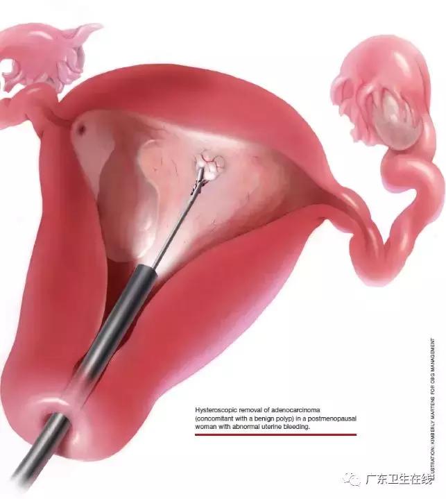 宫内疾病诊断有了大改变，广东这家医院做到免麻醉、不分年龄段