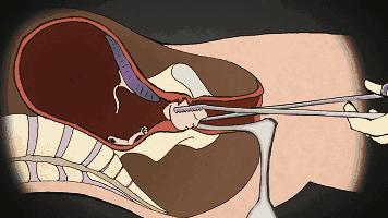男用避孕药通过试验,网友:叫刘阳打针,半藏森林你不用吃药了