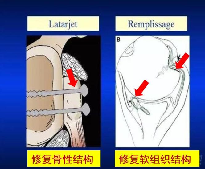 习惯性肩关节脱位怎么办,怎么检查肩关节是不是习惯性脱位