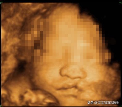 胚胎查出唇腭裂有什么后果,唇腭裂胎儿生下来怎么办