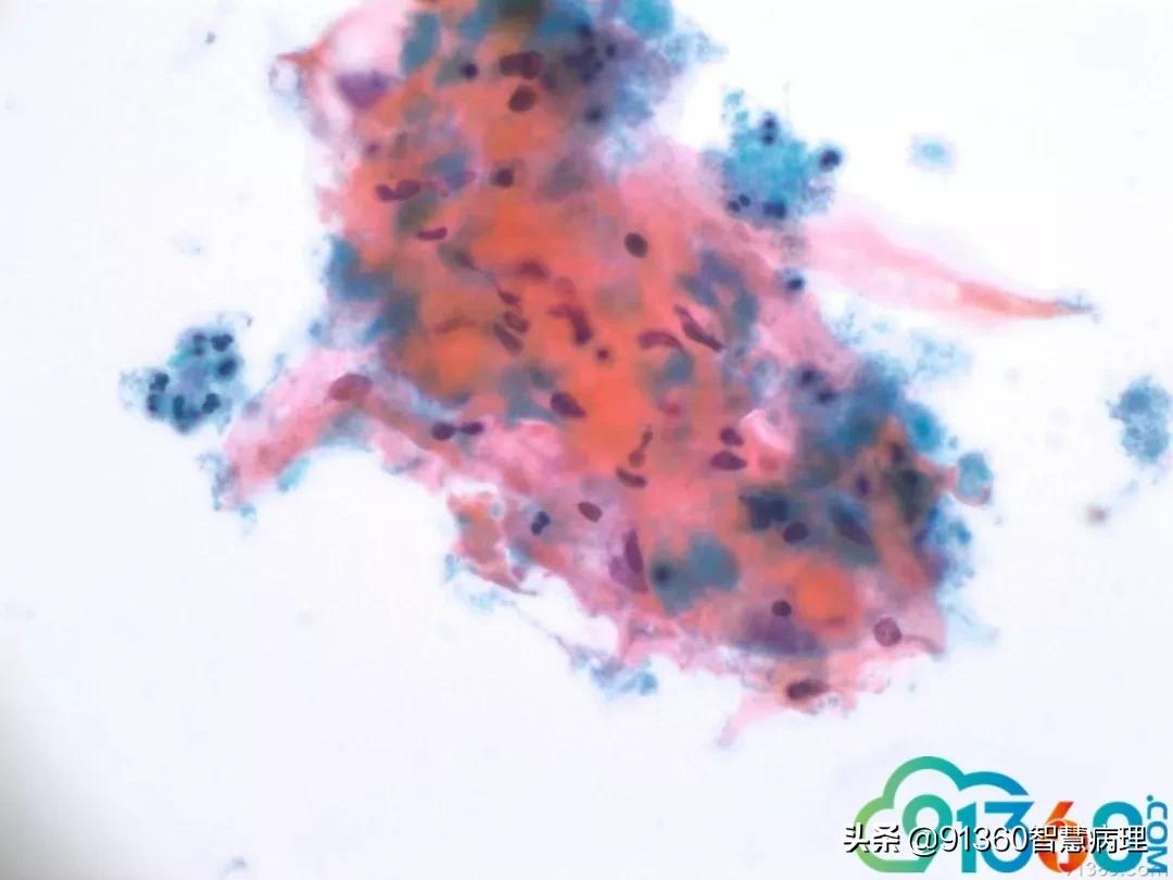 宫颈病理检查与tct检查的区别,病理诊断宫颈活检鳞癌