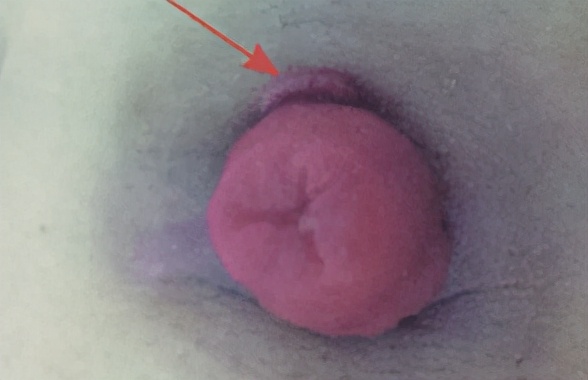 你知道造口粘膜肉芽肿的护理措施吗？