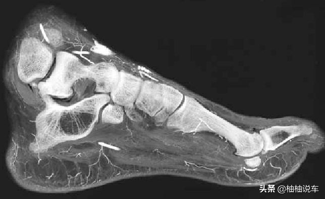 车从脚上压过去有事吗,小车从脚上压过去会怎么样