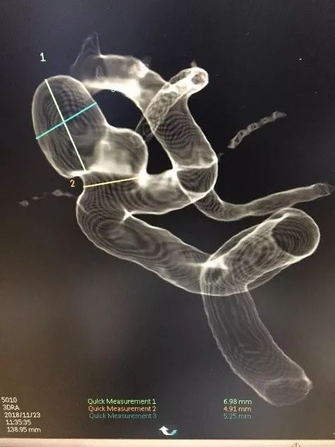 Tubridge®治疗多发性动脉瘤