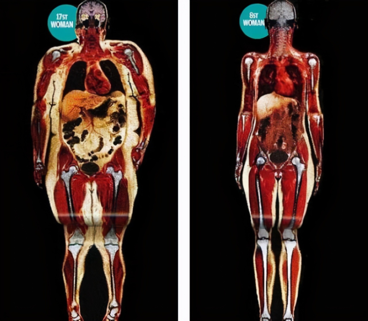 减肥后肚皮下垂松弛怎么办,减肥皮肤下垂松弛怎么办