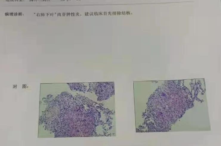9mm肺结节实性结节良性几率多大,良性肺结节生长速度