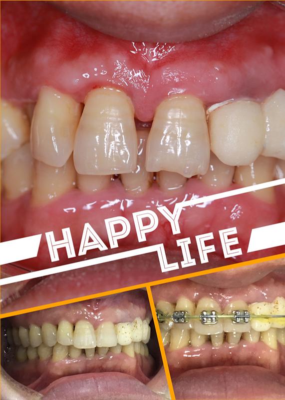 40岁矫正牙齿真实经历,40岁了牙齿龅牙怎么快速矫正