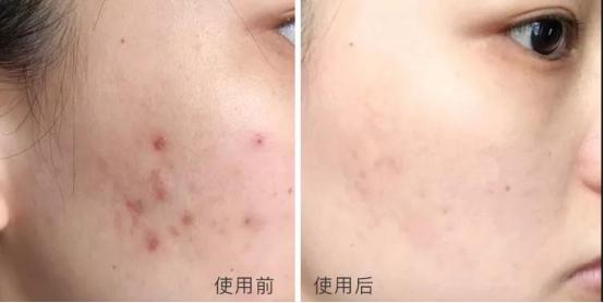 浠欎汉鎺岀棙鑲屼慨鎶よ啅,鐪嬪畬鐥樼棙浠ュ悗鎰熻鏇翠弗閲嶄簡