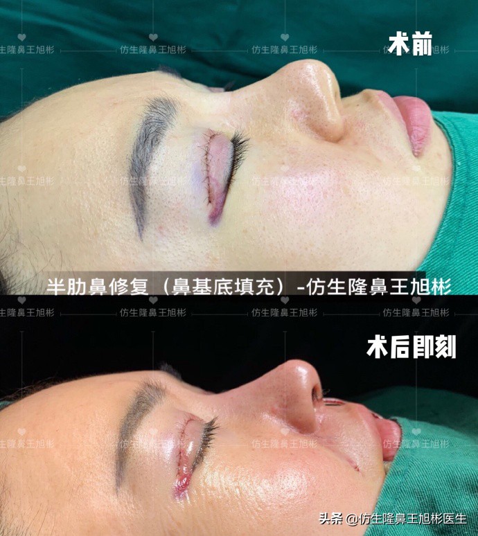 鼻尖整形最简单方法,鼻尖整形的方法图解