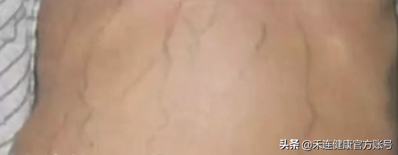 癌症肚子又胀又大是什么癌,什么癌症晚期症状是肚子变大