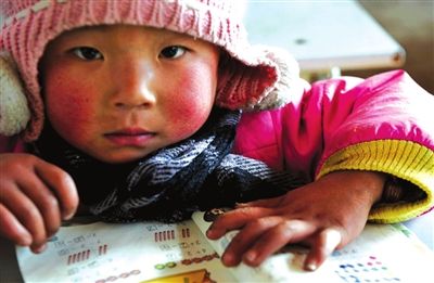 红血丝是脸皮薄还是厚,潮红型红血丝怎么去修复