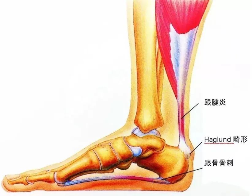 脚后跟上方2-3厘米有一个硬疙瘩疼,脚后跟长了一个包走路特别疼