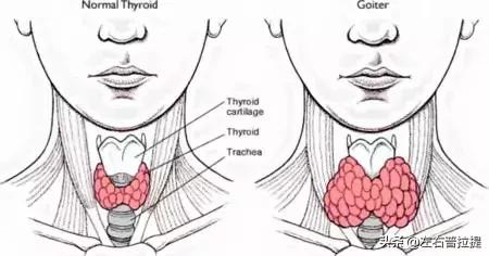 瑜伽治疗甲状腺的动作有哪些,改善甲状腺功能的瑜伽动作