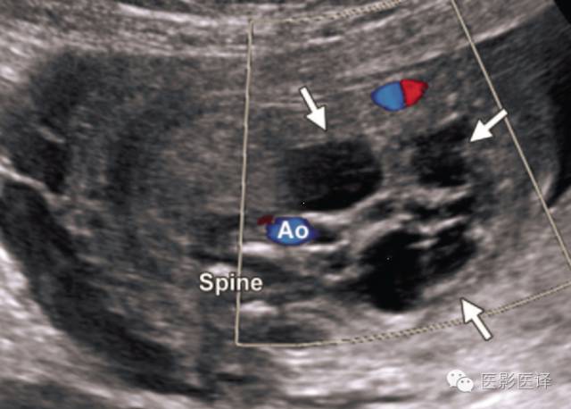 孕期发现卵巢囊肿有8cm左右,孕19周查出胎儿卵巢囊肿