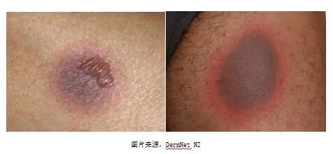 服药后皮肤反复出现红斑，这是与药物相关的一种皮肤疾病