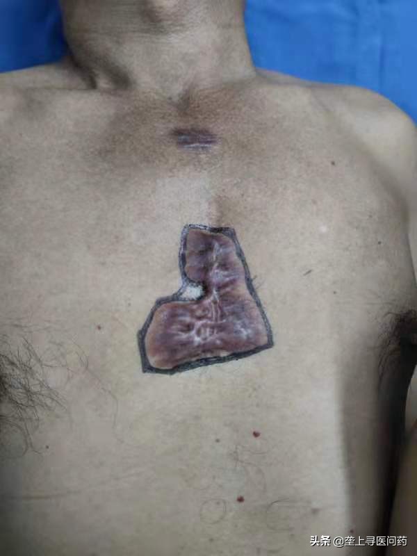 前胸口疤痕修补,小伙胸口疤痕疙瘩切除