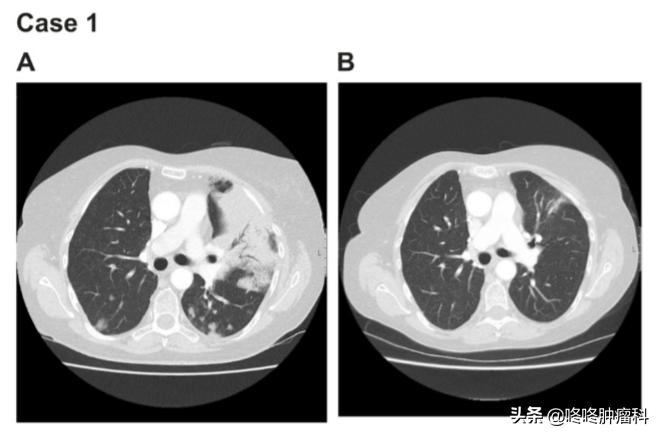 治癌症的靶向药有副作用吗,抗癌靶向药肺癌