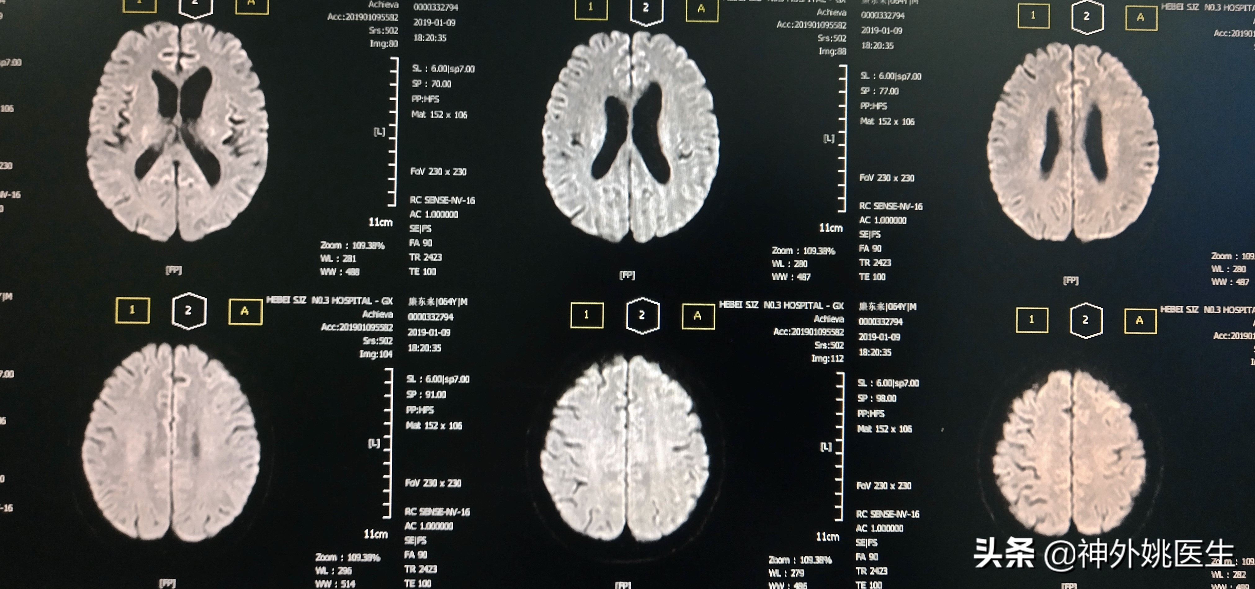 颈内动脉狭窄内膜剥脱术风险大吗,颈动脉内膜摘除手术