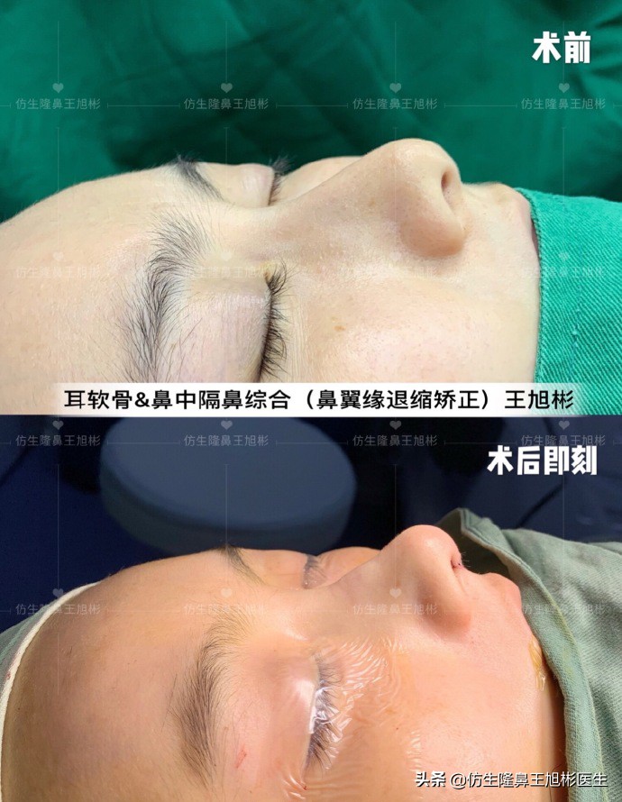 王旭彬：朝天鼻、露鼻孔，模特菲菲短鼻矫正手术后1.5个月