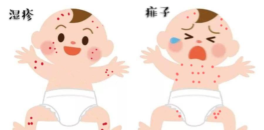 婴儿湿疹反复妈妈要忌口吗,宝宝湿疹反反复复怎么根除