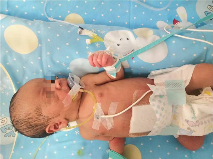 怀孕肚皮表面撕裂生完是怎么样的,胎儿肚皮开裂