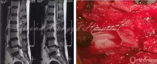 经皮腰椎间盘切除术有何优缺点,什么是经皮内镜腰椎手术