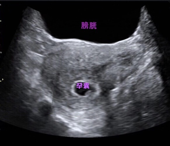 超声检查膀胱壁毛糙可以吃什么药,做膀胱彩超检查用憋尿吗