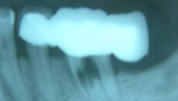 固定牙搭桥多少钱,固定桥修复牙齿价格