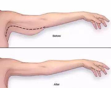 紧致蝴蝶臂的最快方法,紧致蝴蝶臂